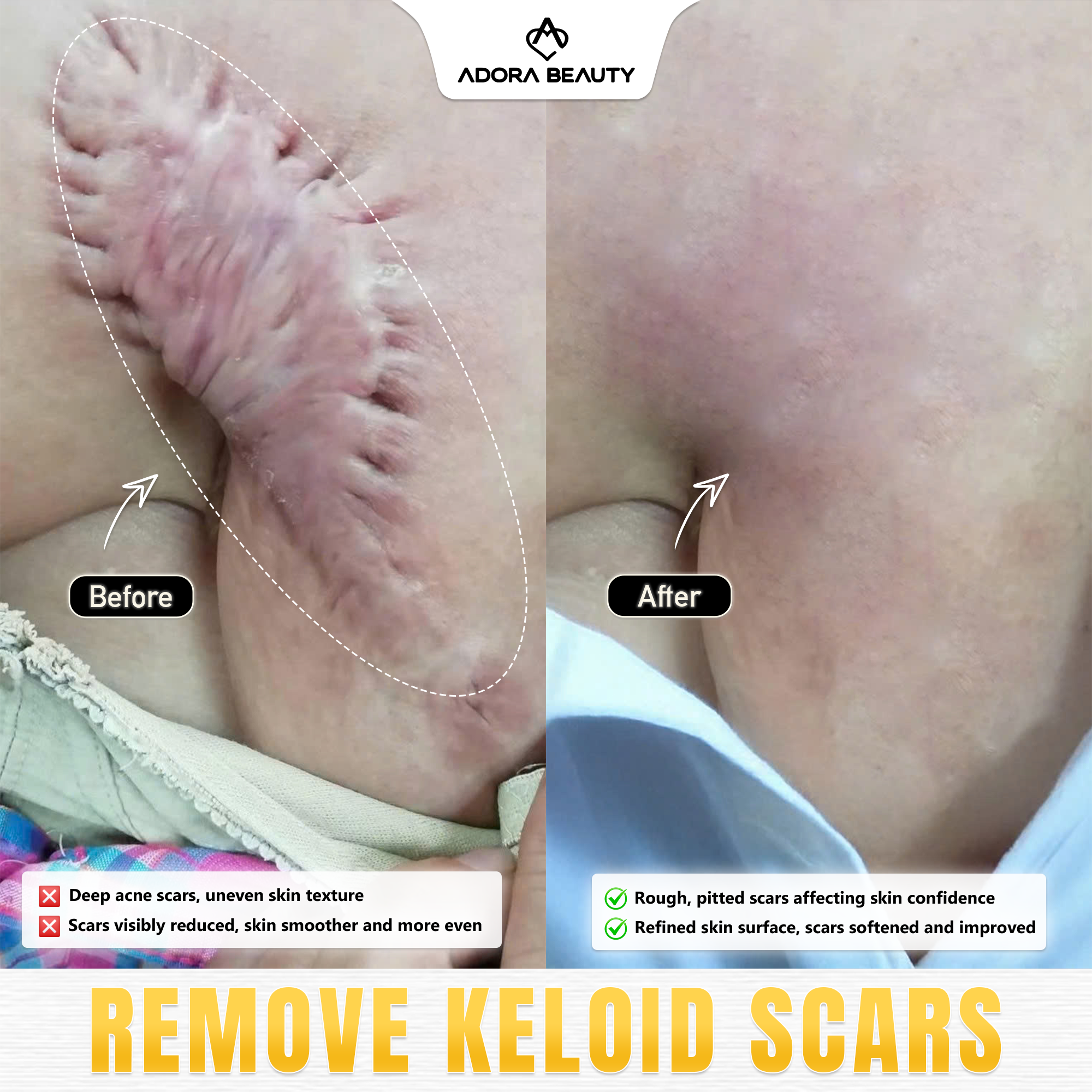 ADORA Beauty center - Manila city Facebook ad: 99,231 customers treated their scars successfully!
