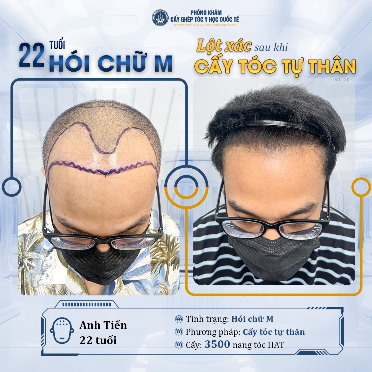Bệnh Hói Đầu - Y Học Hà Nội Facebook ad: GIẢM 35% CHI PHÍ