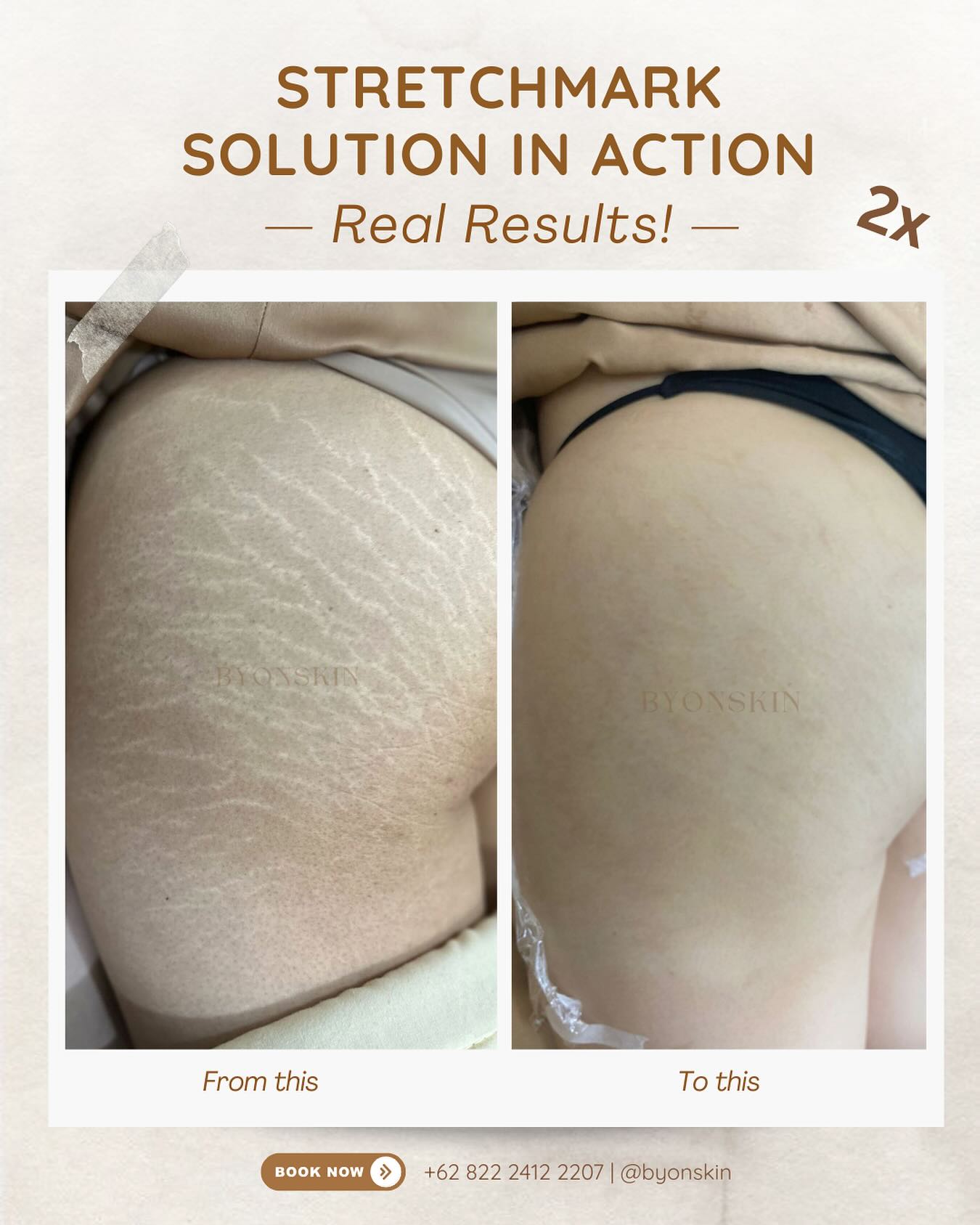 Byonskinpik Facebook ad
