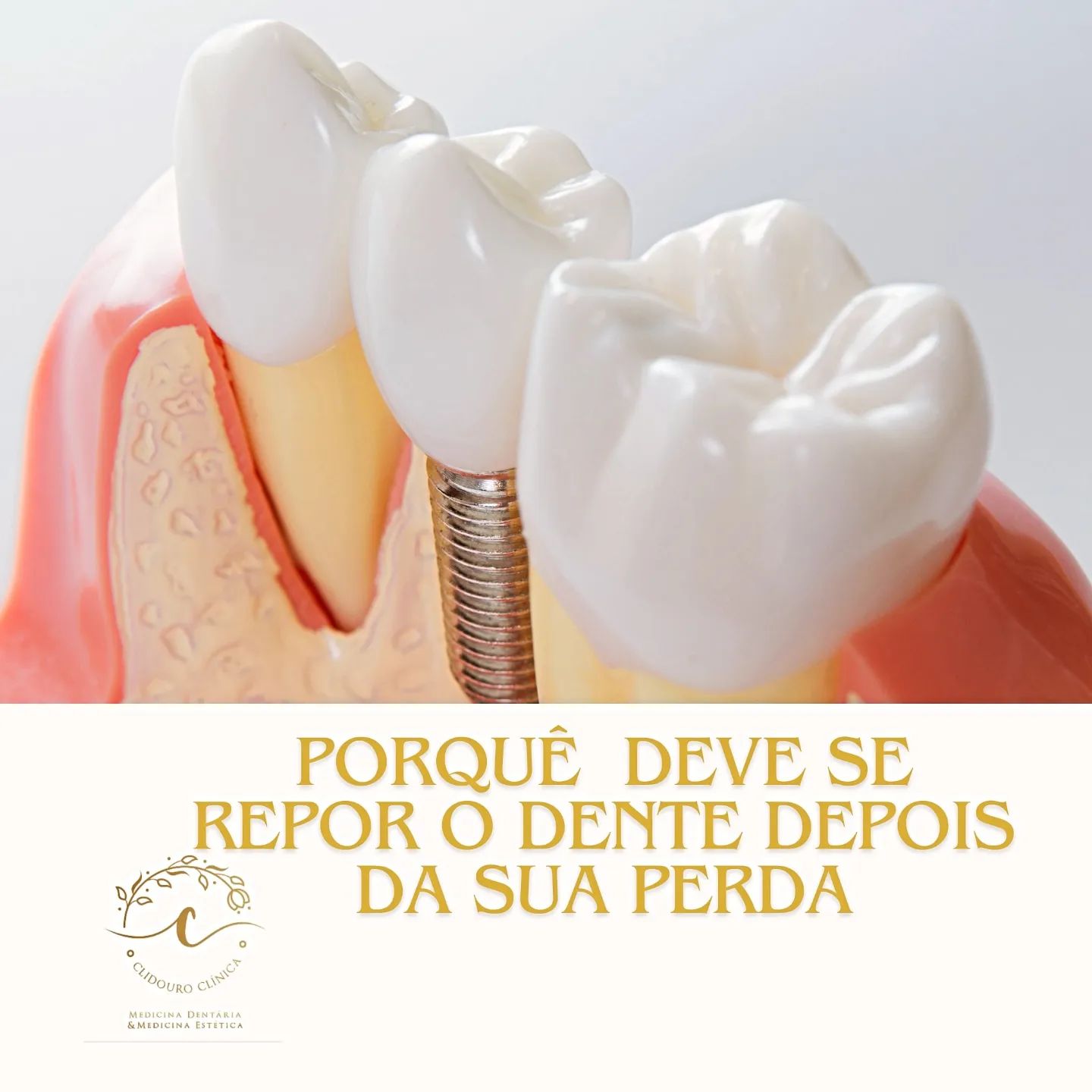 bruna_estevez Facebook ad: A IMPORTÂNCIA DE SUBSTITUIR OS DENTES PERDIDOS.