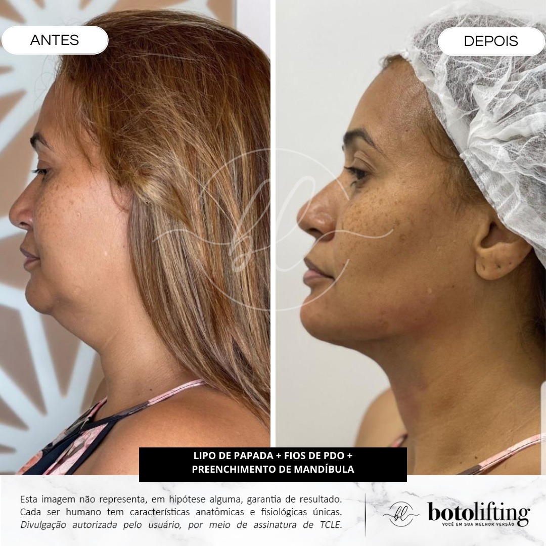Botolifting Teresópolis Facebook ad: Estamos oferecendo um pacote exclusivo que combina três…
