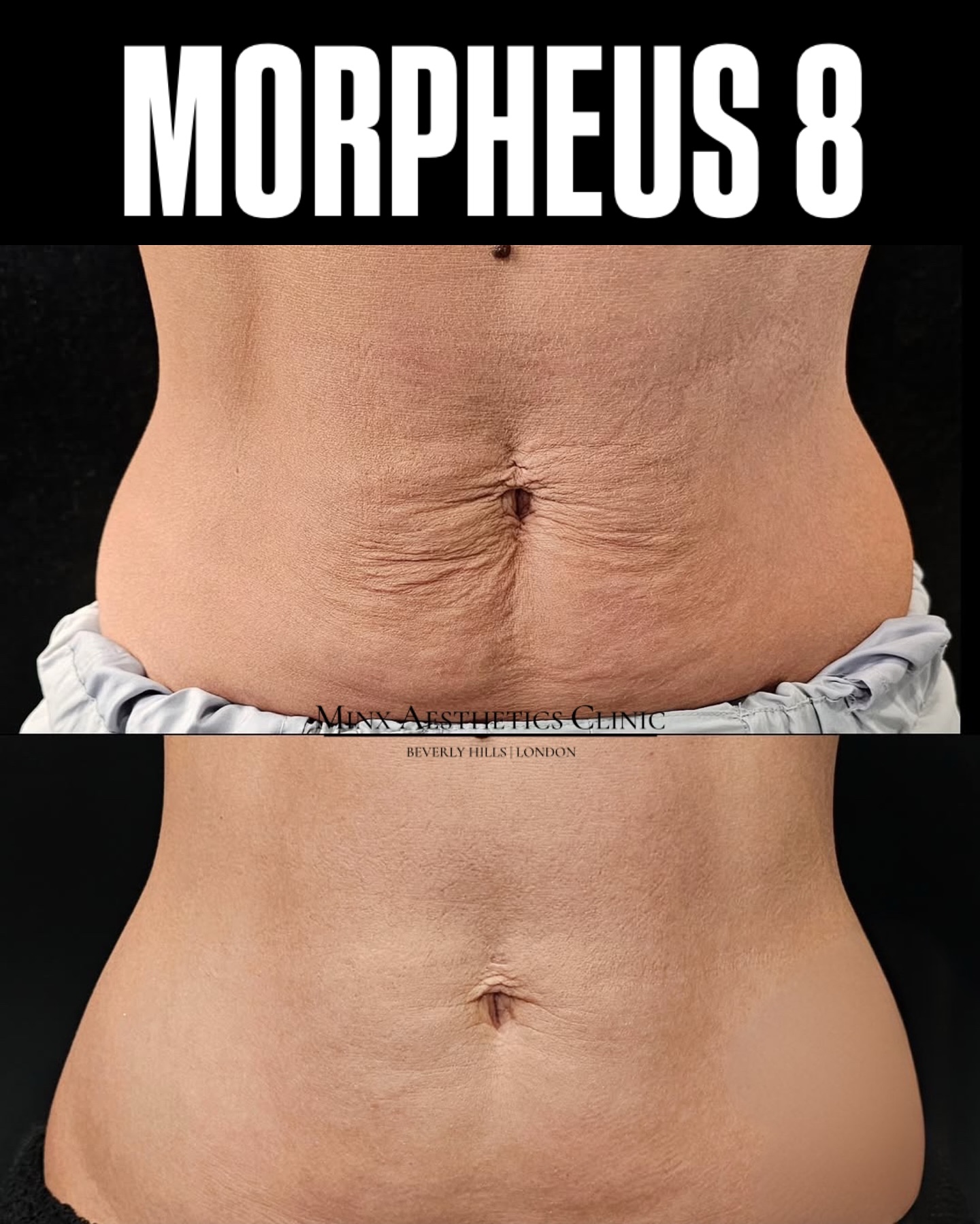 Minxaesthetics Facebook ad: Before and after results with MORPHEUS 8