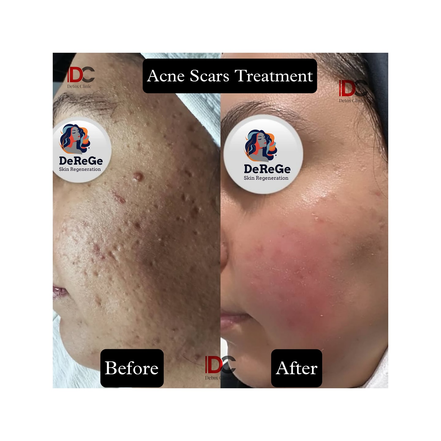 Detox Clinic Facebook ad: Successful Results Of Acne Scars By DeGeRe Treatment