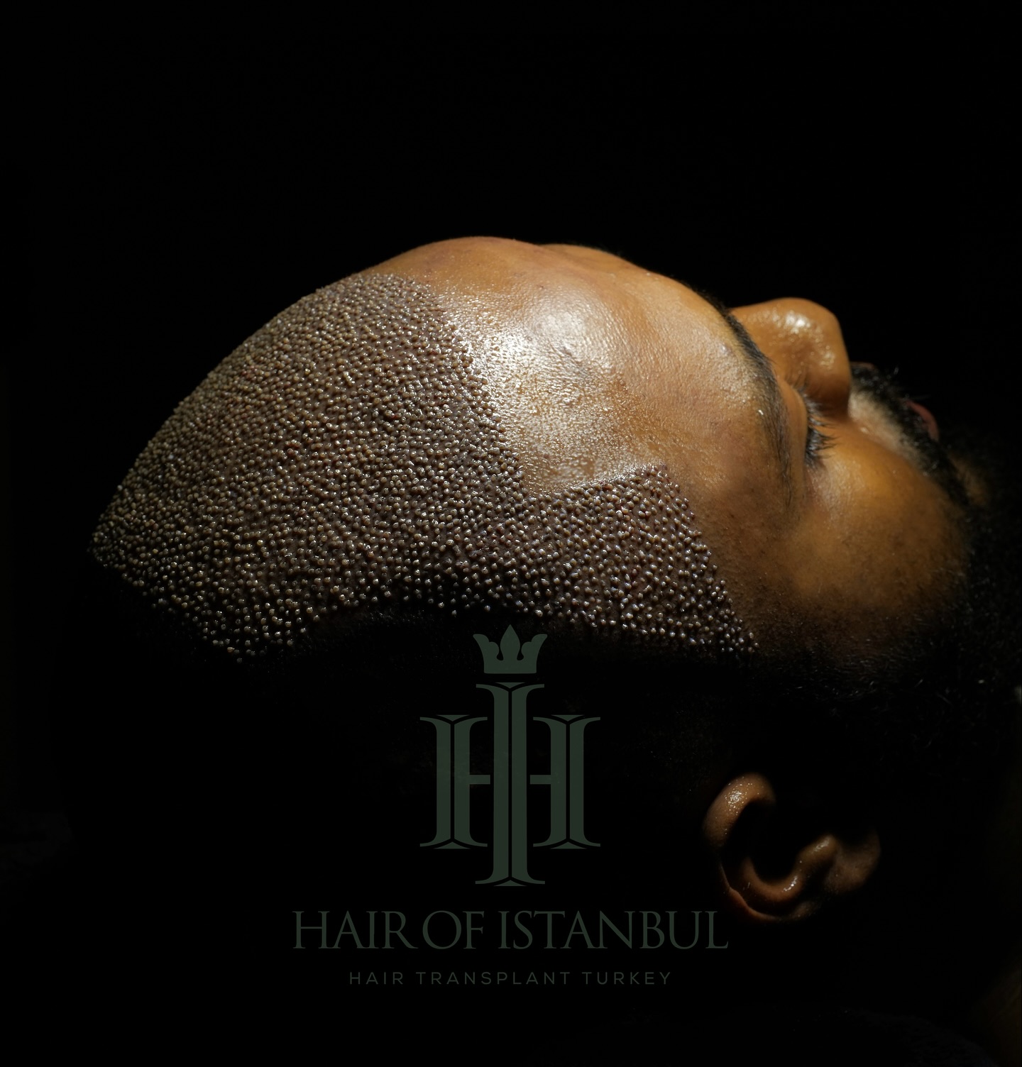 Hair of İstanbul Facebook ad