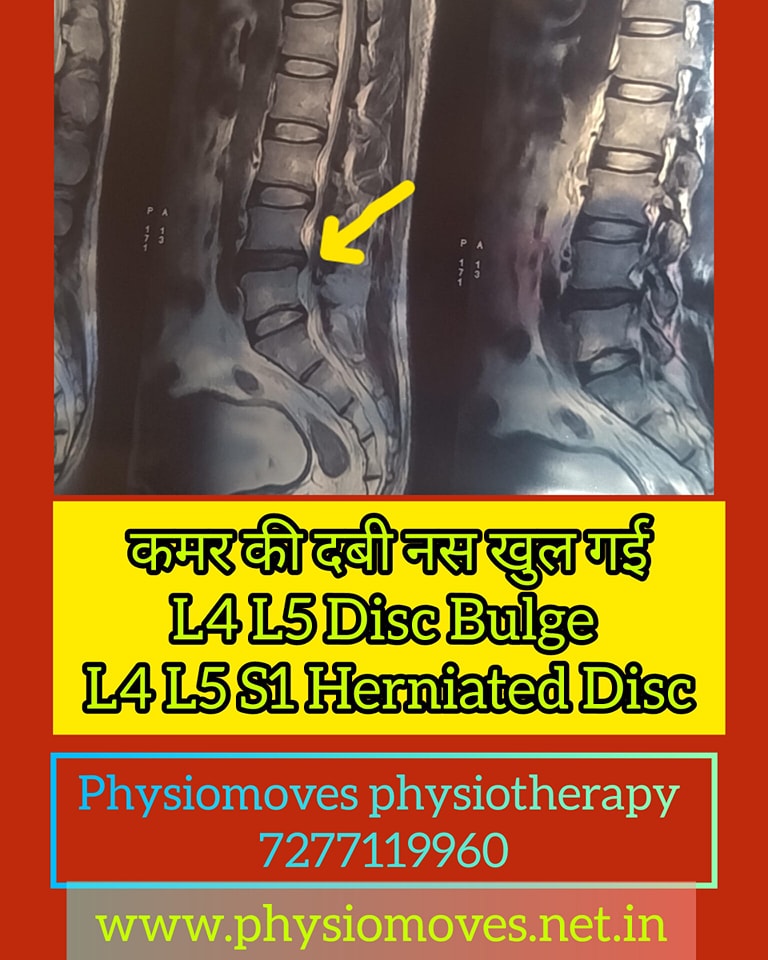 PhysioMoves Jamshedpur Facebook ad: Chiropractic care in Jamshedpur offers effective solutions…