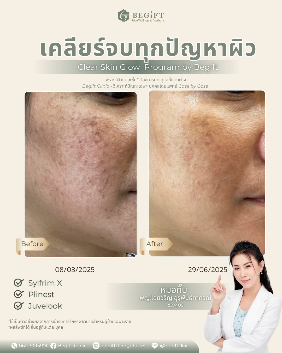 Begift Clinic Phuket Facebook ad: กระ จุดด่างดำ เคลียร์จบ!