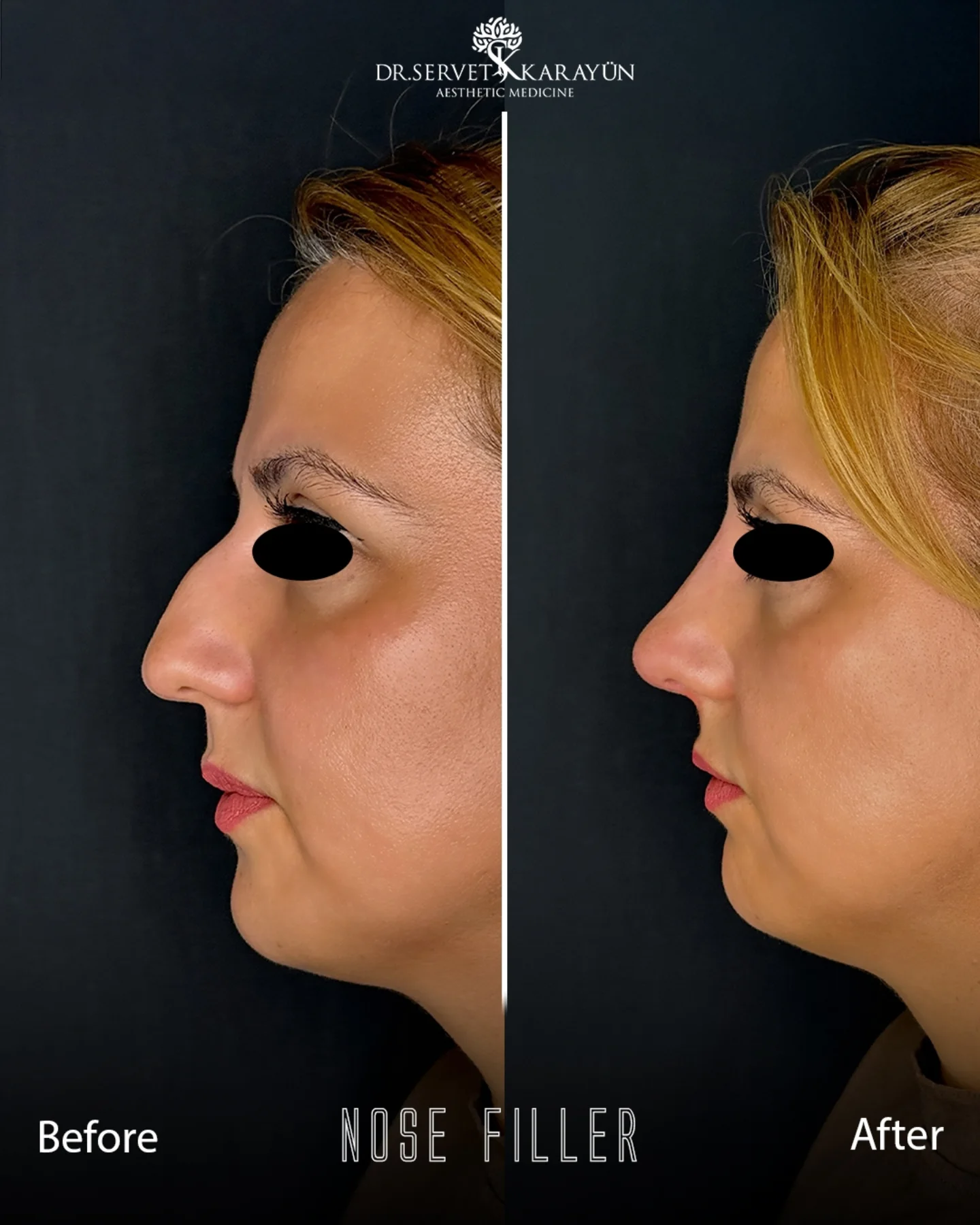 drservetkarayun Facebook ad: Nose Filler