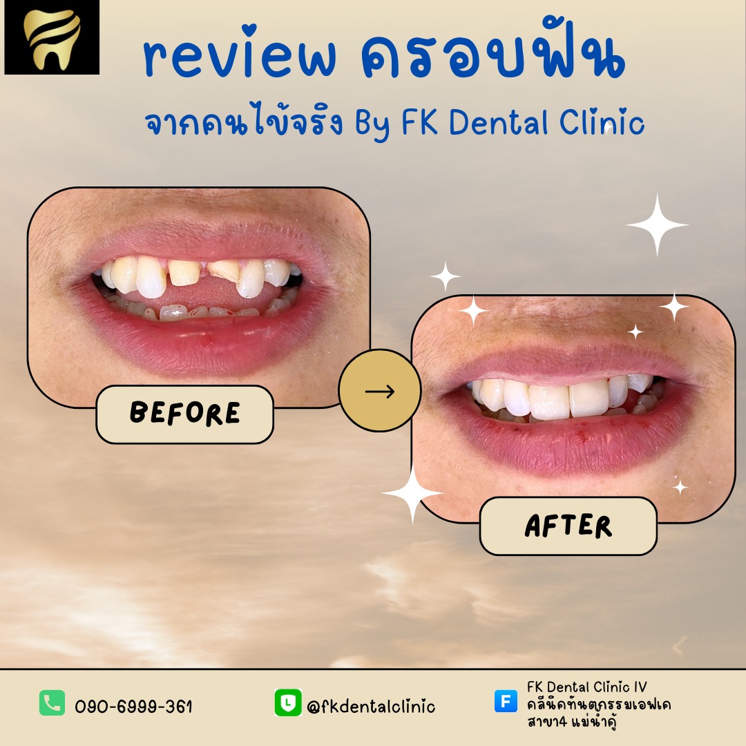 FK Dental Clinic III คลีนิคทันตกรรมเอฟเค สาขา3 หนองก้างปลา Facebook ad: ครอบฟันเพื่อการปกป้องที่เหนือกว่า…