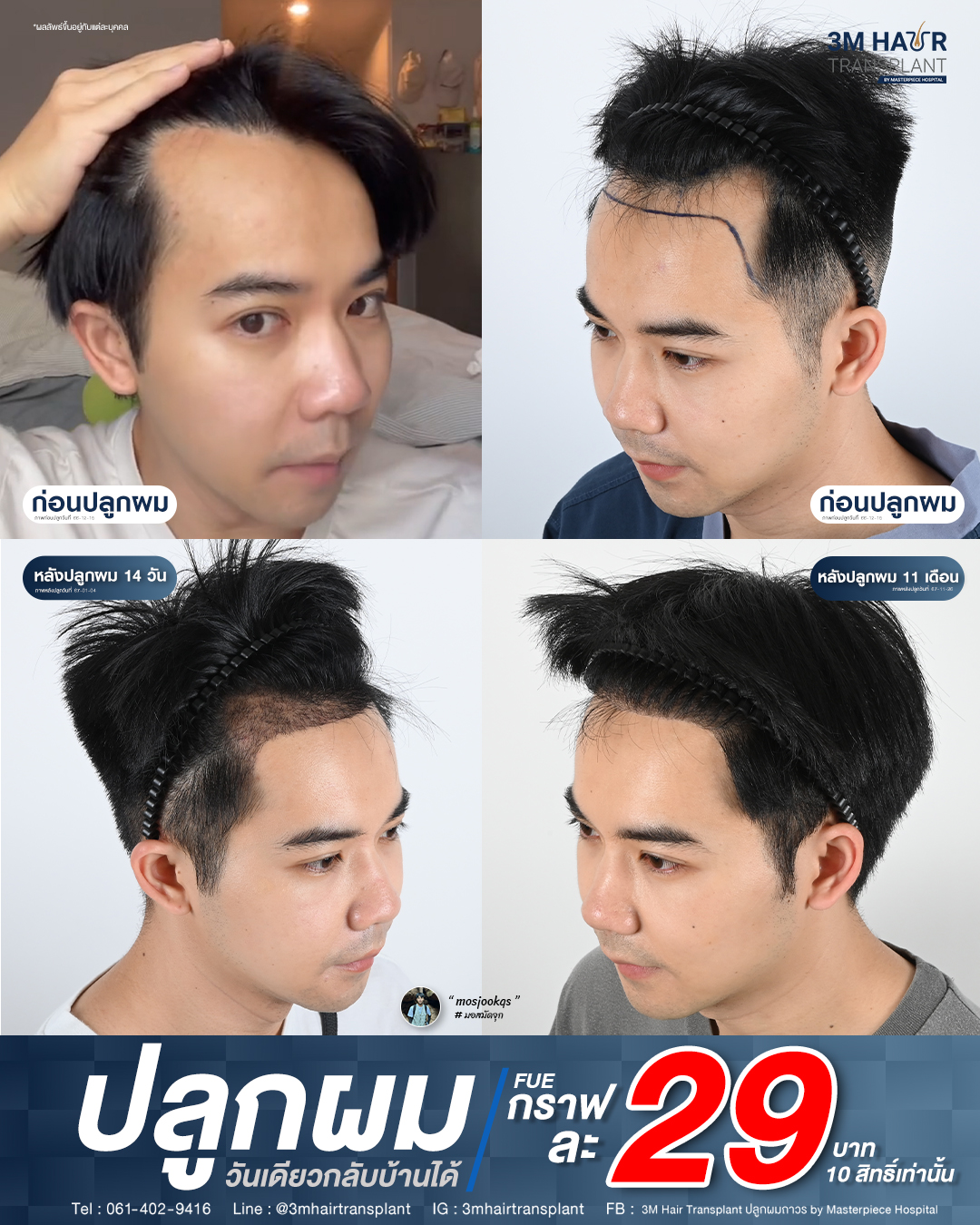 3M Hair Transplant ปลูกผมถาวร by Masterpiece Hospital Facebook ad