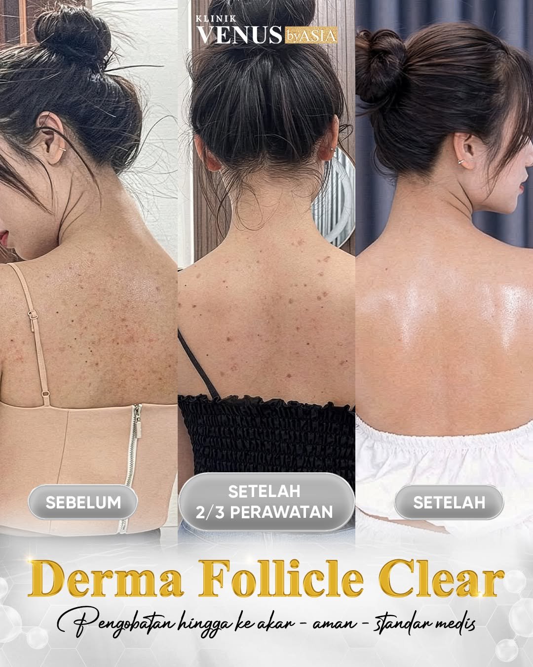 Derma Follicle By Venus Aisa Facebook ad: PUNGGUNG BERSIH DARI FOLIKULITIS, KULIT LEBIH HALUS SETELAH…
