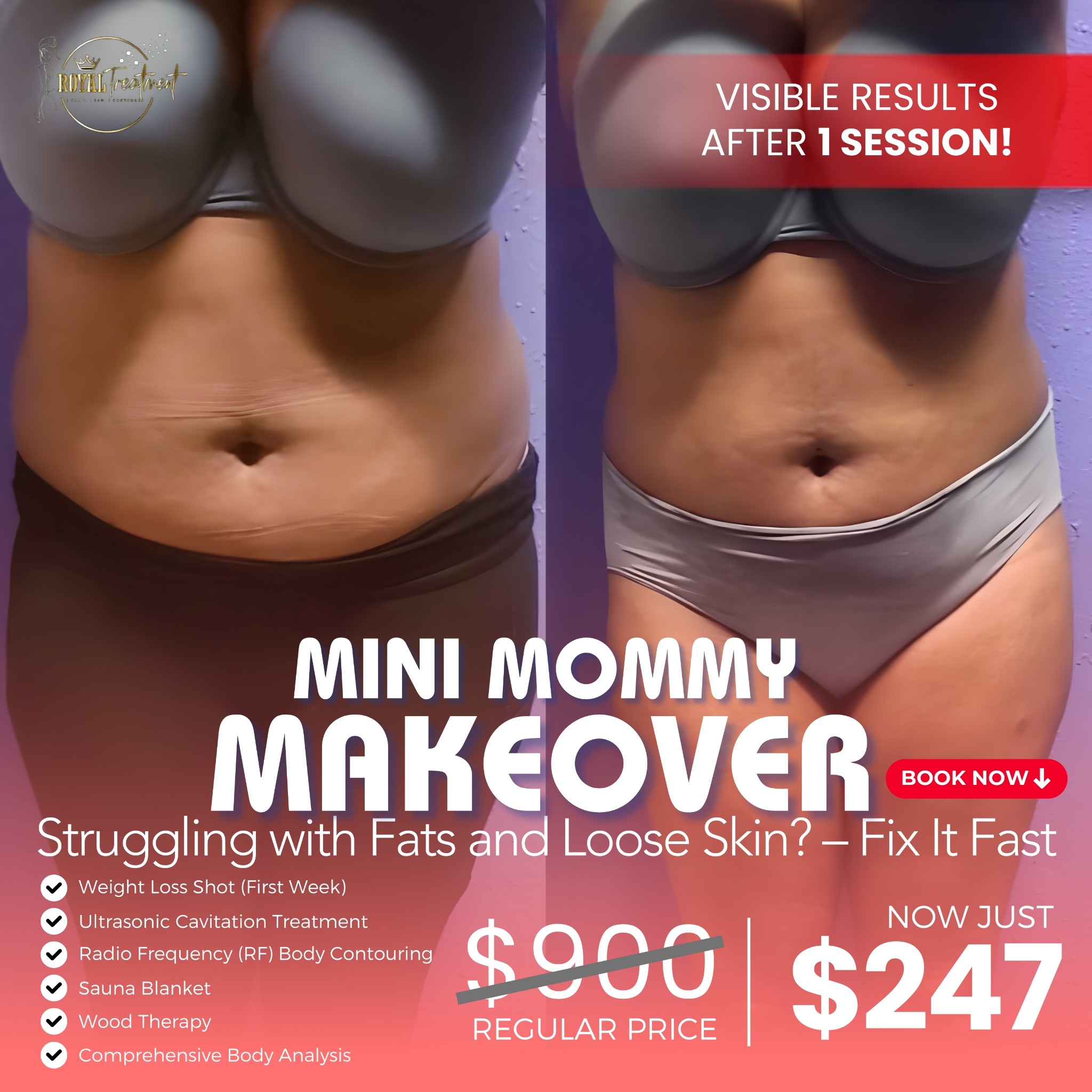 Royal Treatment Body Contouring Facebook ad: $247 Mini Mommy Makeover today
