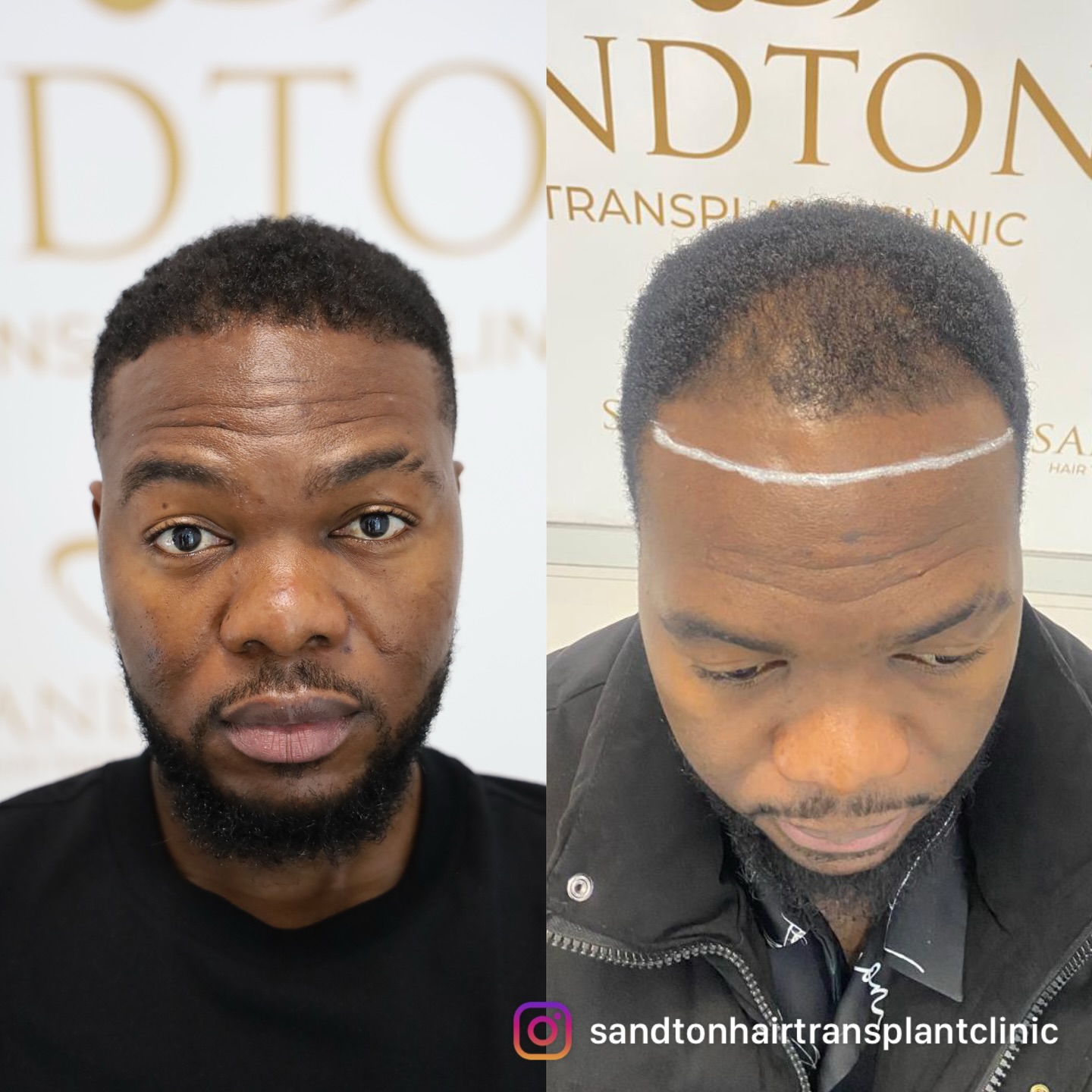 Sandton Hair Transplant Clinic Facebook ad