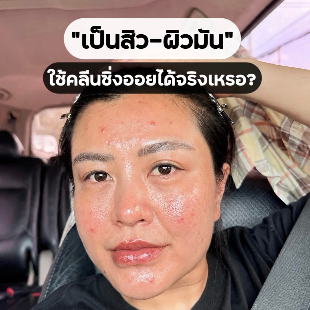 เกศแก้วป้ายยา Facebook ad: เป็นสิว-ผิวมัน ใช้คลีนซิ่งออยได้จริงเหรอ