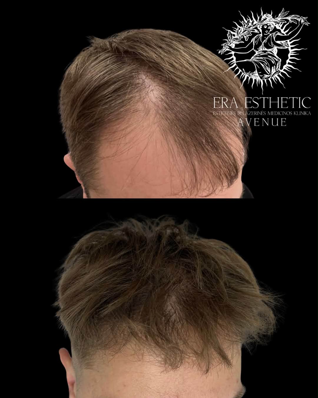 Era Esthetic - Lazerinės Dermatologijos Klinika Facebook ad: Plaukų slinkimo gydymas prasideda ne nuo procedūros, o…