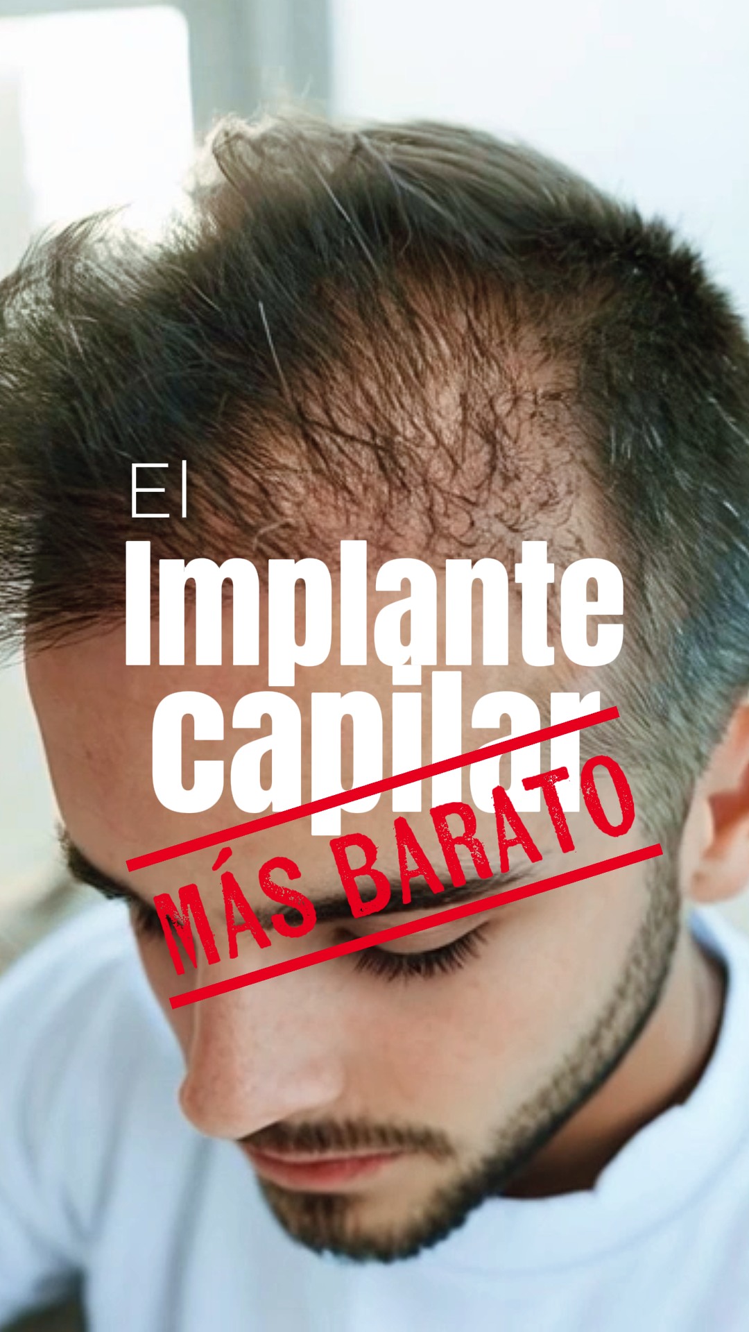 Implante Capilar Buenos Aires Facebook ad: El implante capilar más barato puede terminar saliendo…