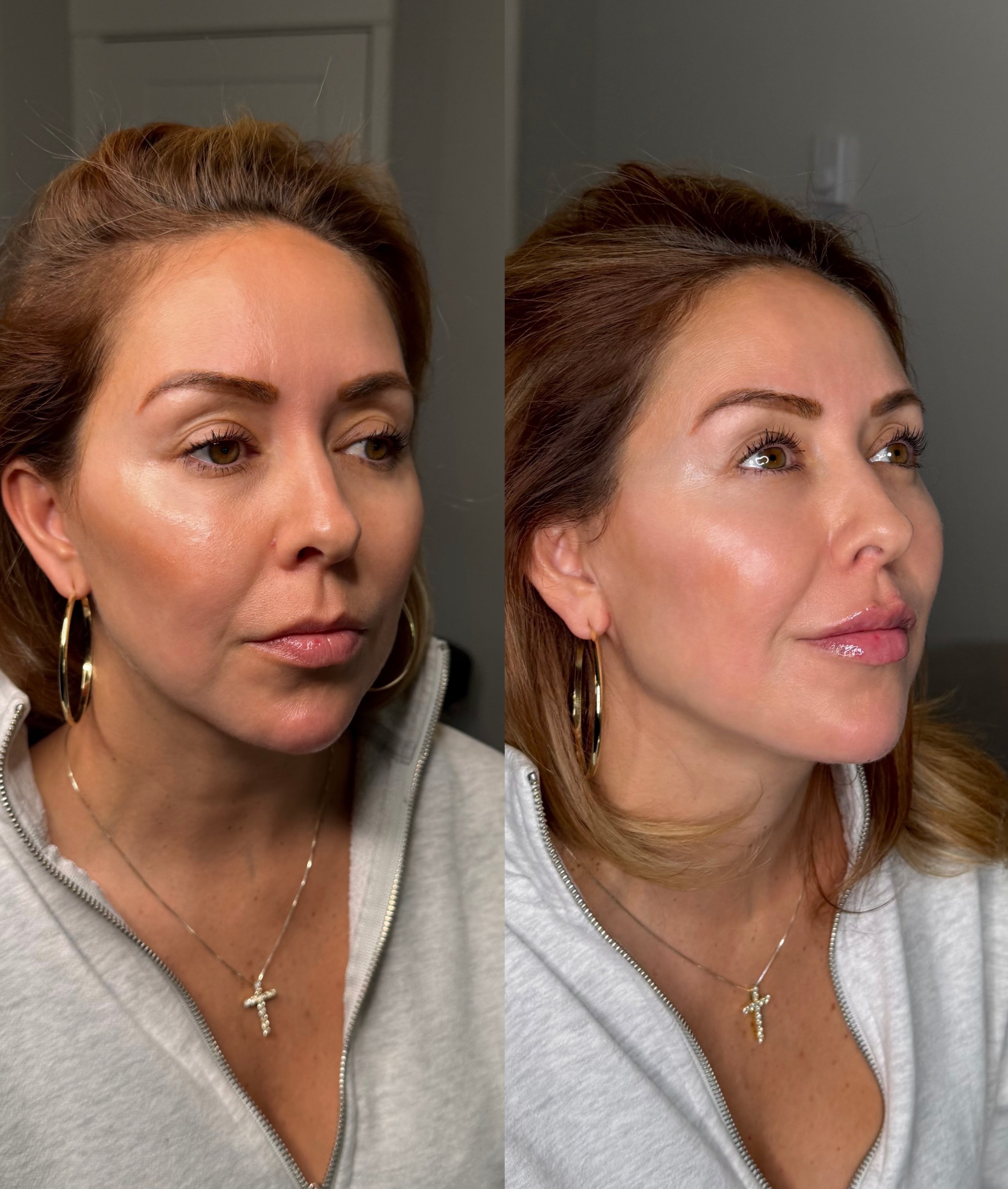 Aesthetic Nurse Marta Facebook ad: Express lower face touch up using 3 ML…