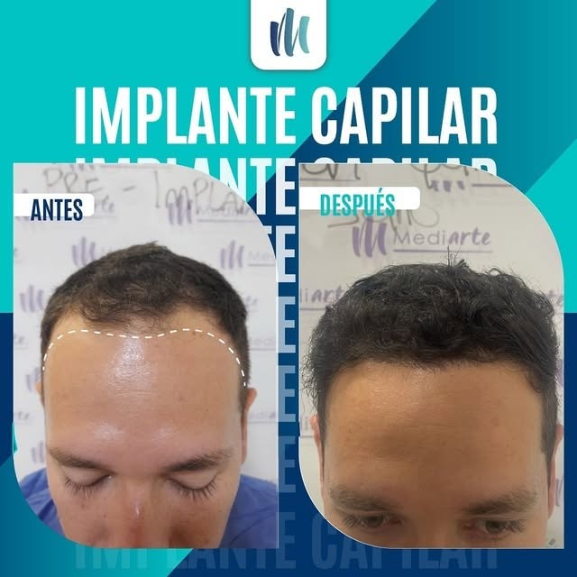 Mediarte implante capilar Villavicencio Facebook ad