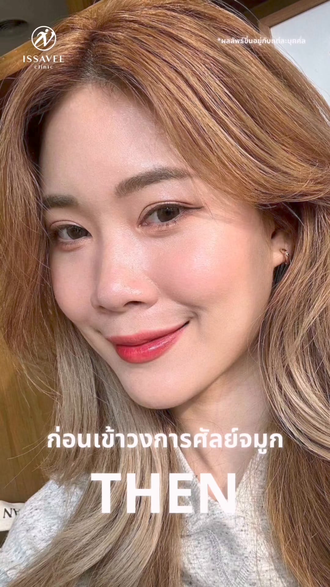 Issavee Plastic Surgery โดยหมอศัลยกรรมตกแต่งเฉพาะทาง Facebook ad: Unique Nose จมูกใหม่ หน้าใหม่ เวอร์ชั่นใหม่…