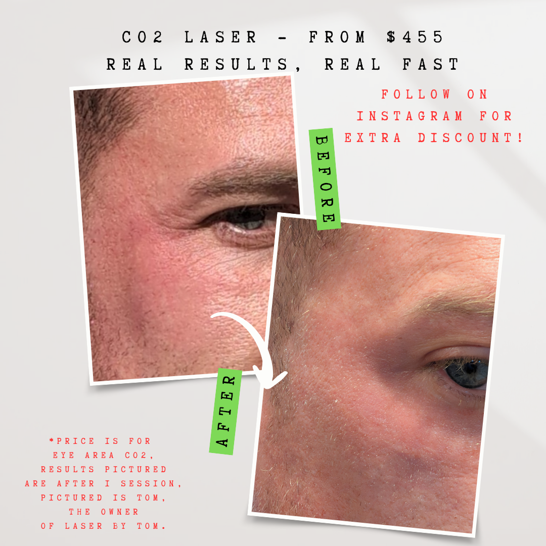 Laser by Tom Facebook ad: Soften wrinkles and fine lines with CO2 Laser!