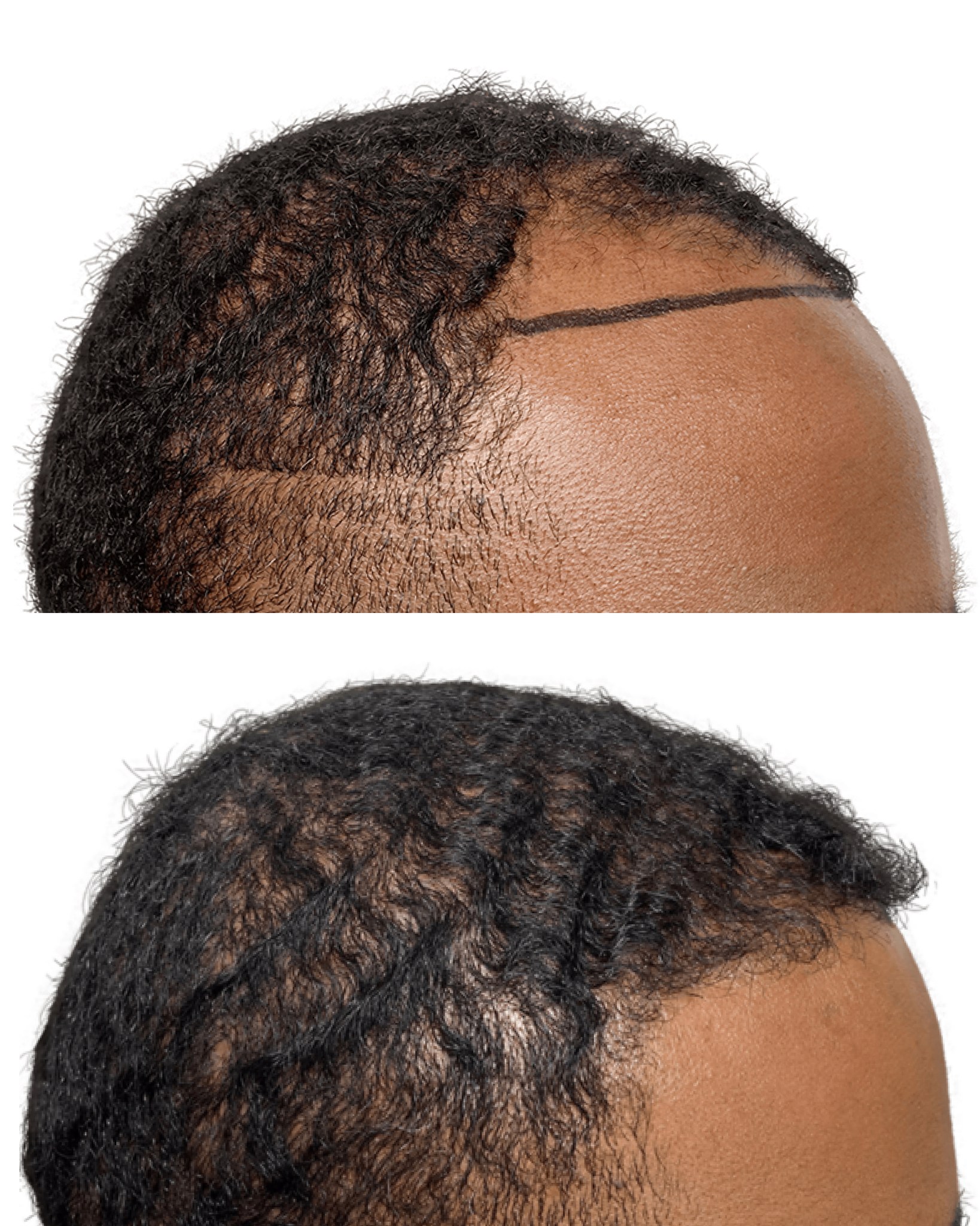 Maxim Hair Restoration Facebook ad: Mamba Mentality!