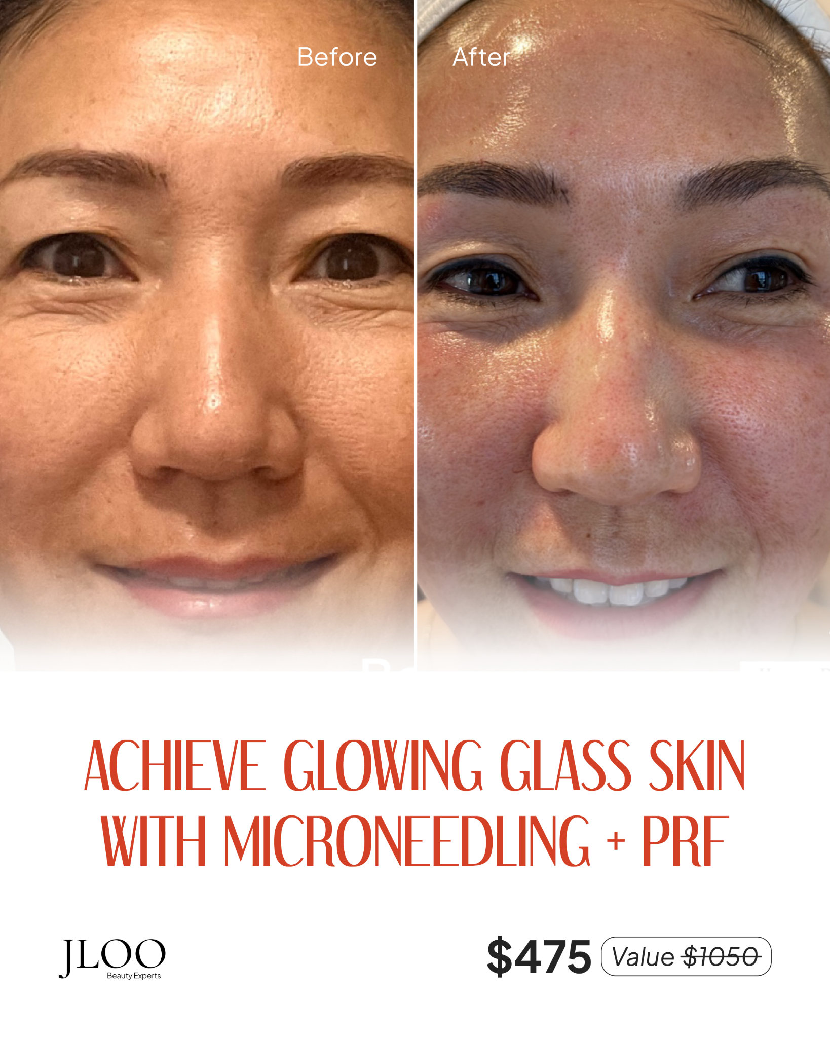 JLoo Beauty Experts Facebook ad: Achieve Glass Skin Glow With Microneedling + PRF