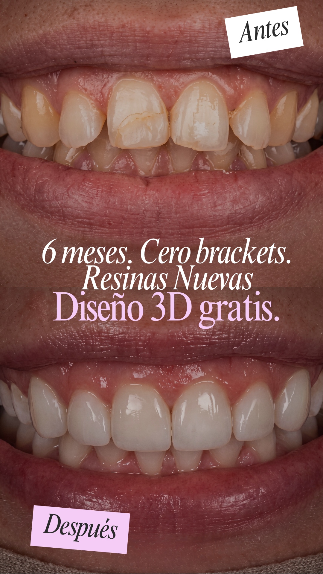 Alineadores Invisibles Allinea Facebook ad: Tu Diseño de Sonrisa 3D es GRATIS