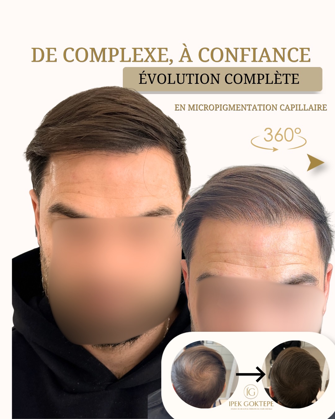 Ipek G. Dermographe Facebook ad: Un manque de densité, ce n’est pas seulement…