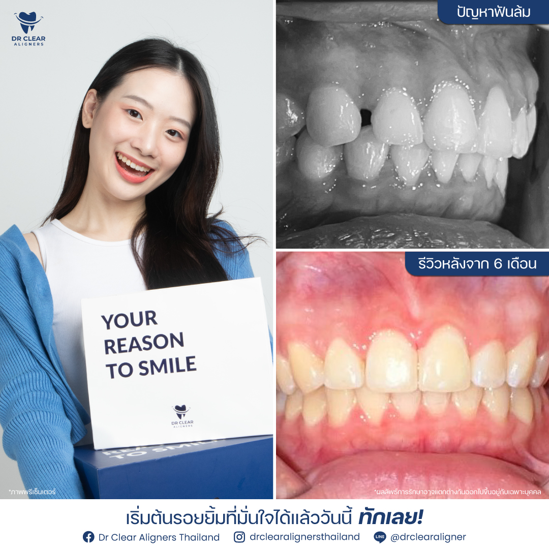 Dr Clear Aligners Thailand Facebook ad