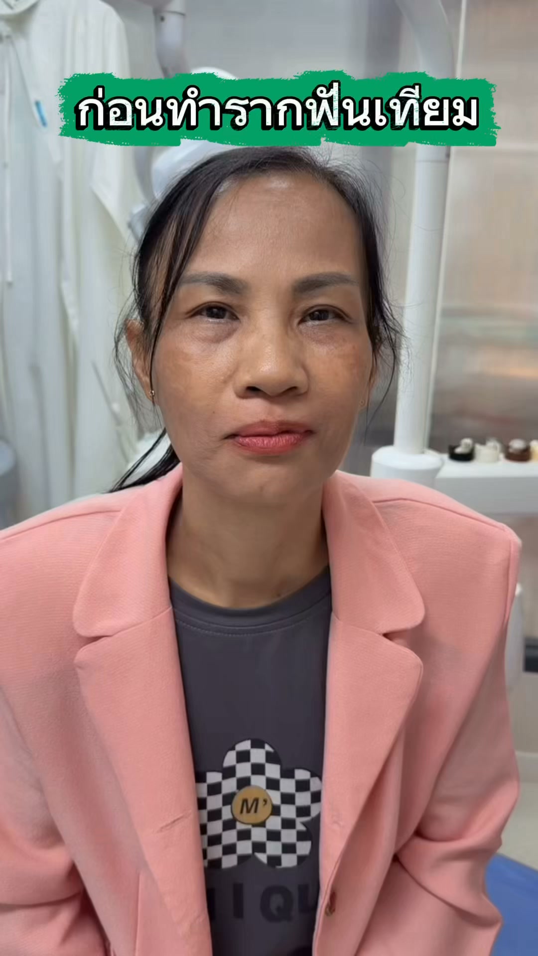 Witcha Dental Clinic ศูนย์รากฟันเทียมทั้งปากตากสิน20 Facebook ad: รากฟันเทียม All on 4 บน,ล่าง