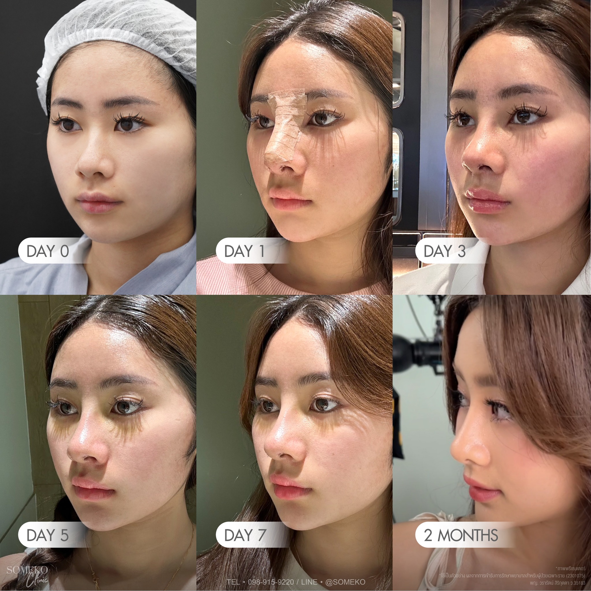 Someko โซเมโกะ Facebook ad: เสริมจมูกเทคนิค SCT (เสริมจมูกแบบ closed)…