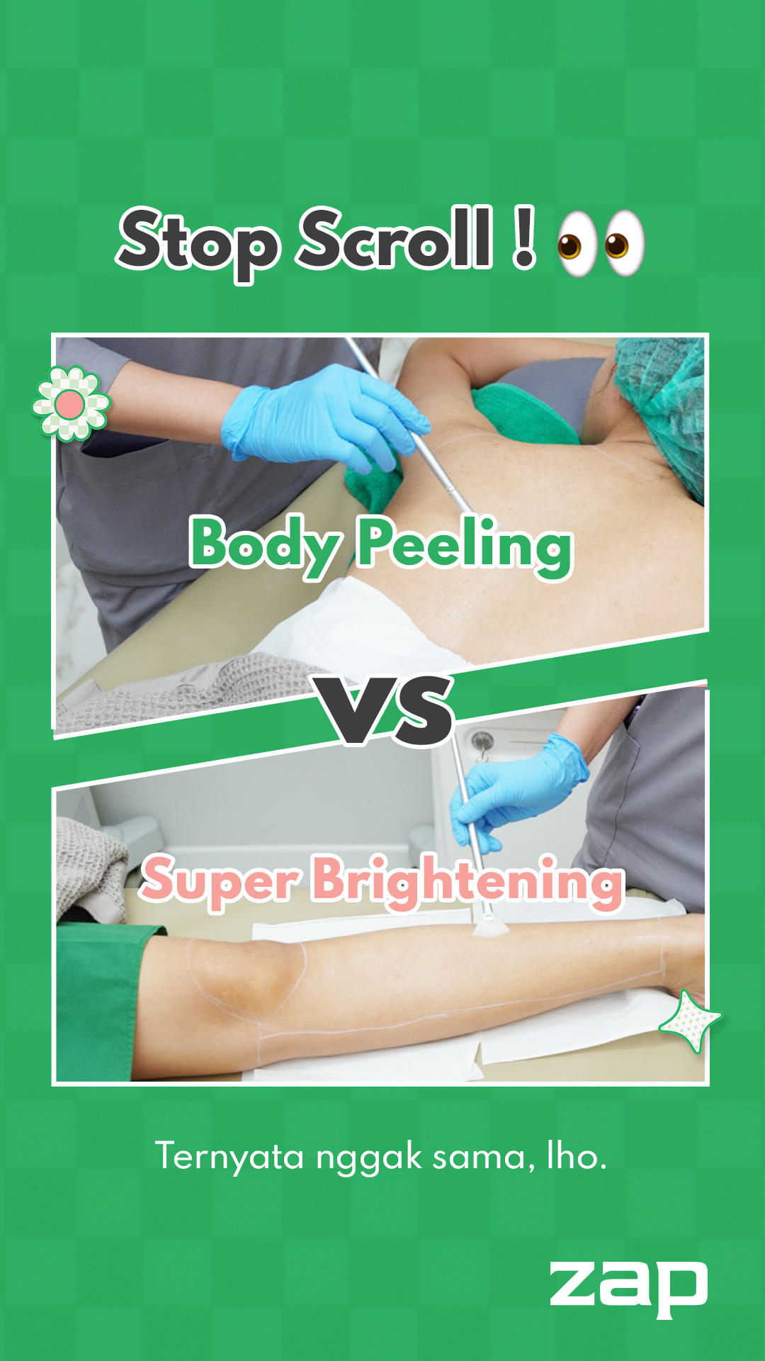 ZAP Hair Removal Facebook ad