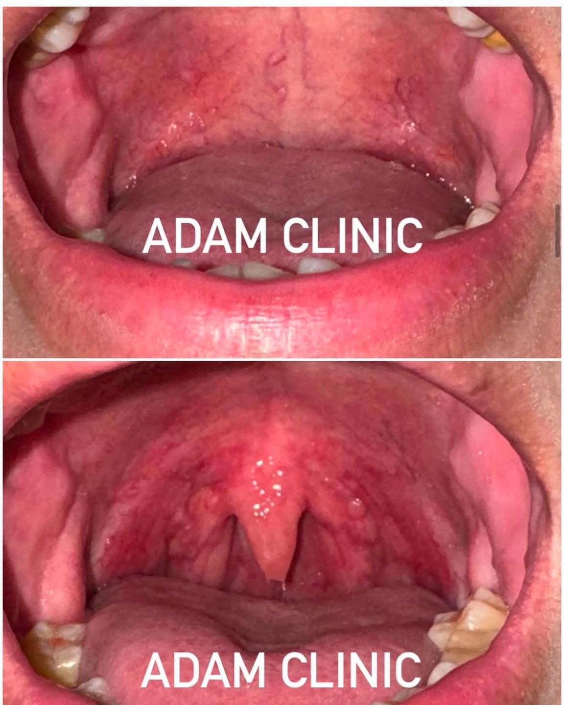 Adam wellness clinic Facebook ad: นอนกรนรักษาได้ ไม่ต้องผ่าตัด!