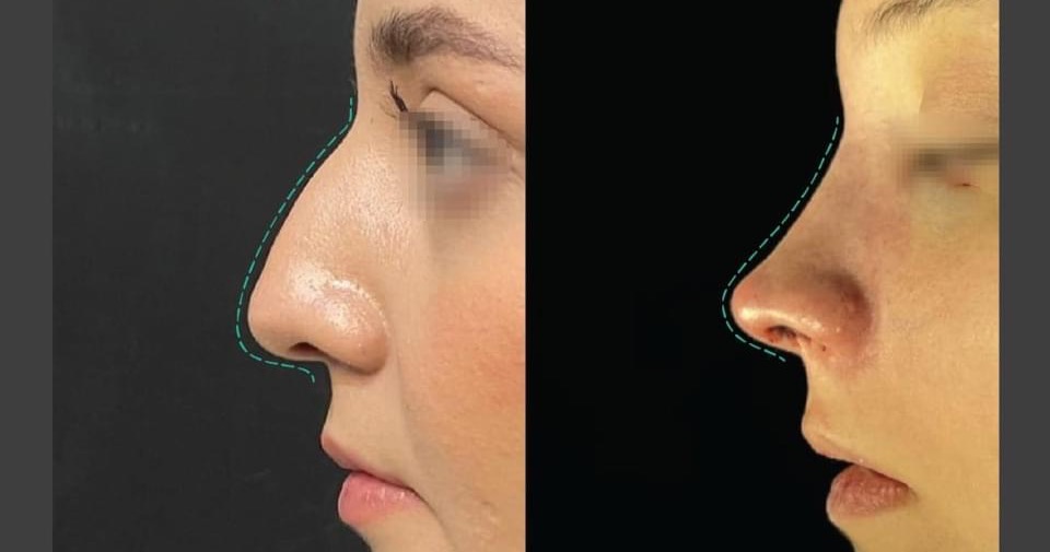 Rinofast Guadalajara Facebook ad: Rinoplastía funcional y estética.