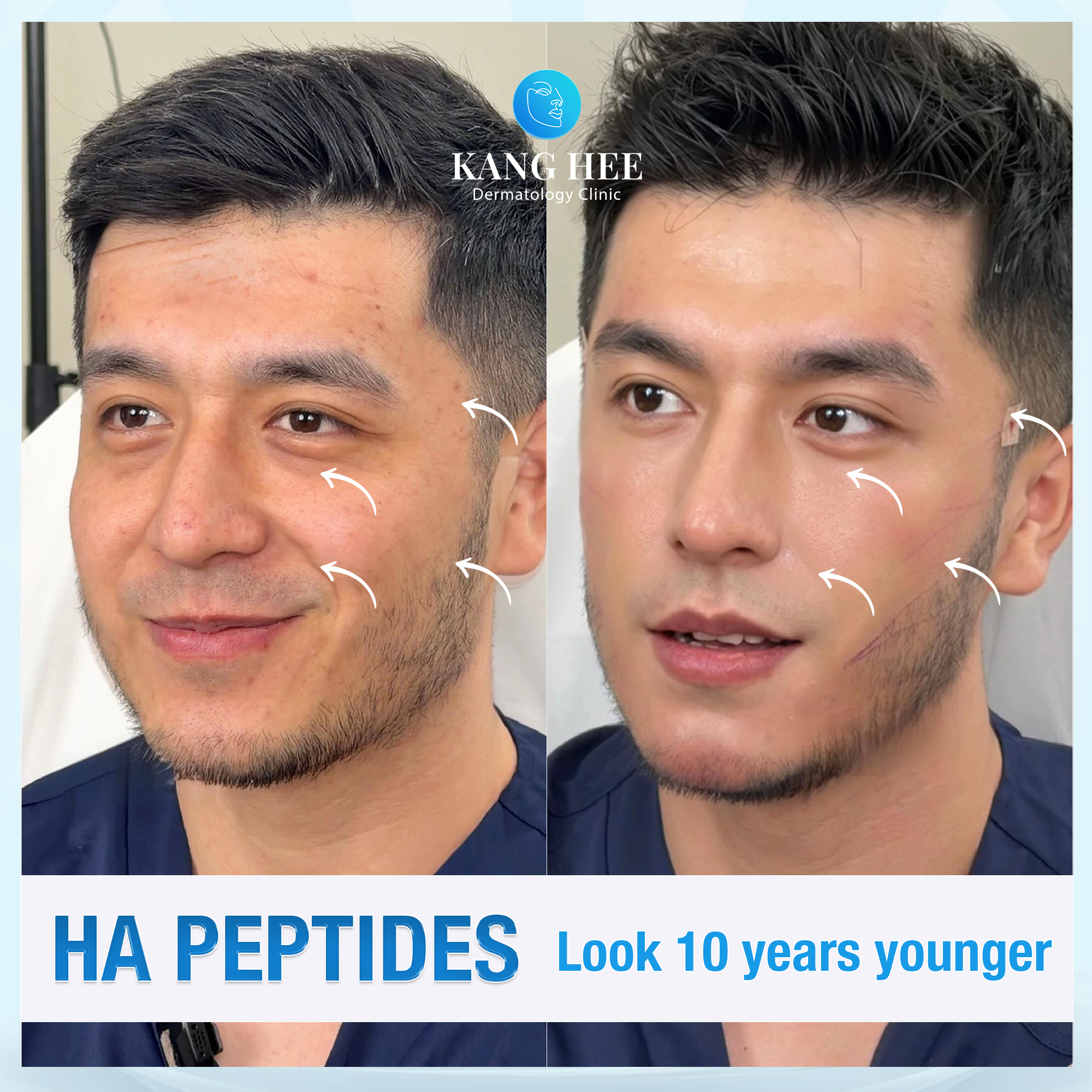 KangHee Royal Aesthetic Clinic Dubai Facebook ad: No surgery | No downtime | Just 30 Minutes
