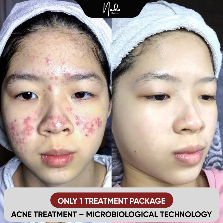 Nado Clinic & Spa - Davao Facebook ad: SEVERE ACNE, THE LONGER YOU WAIT, THE HIGHER…