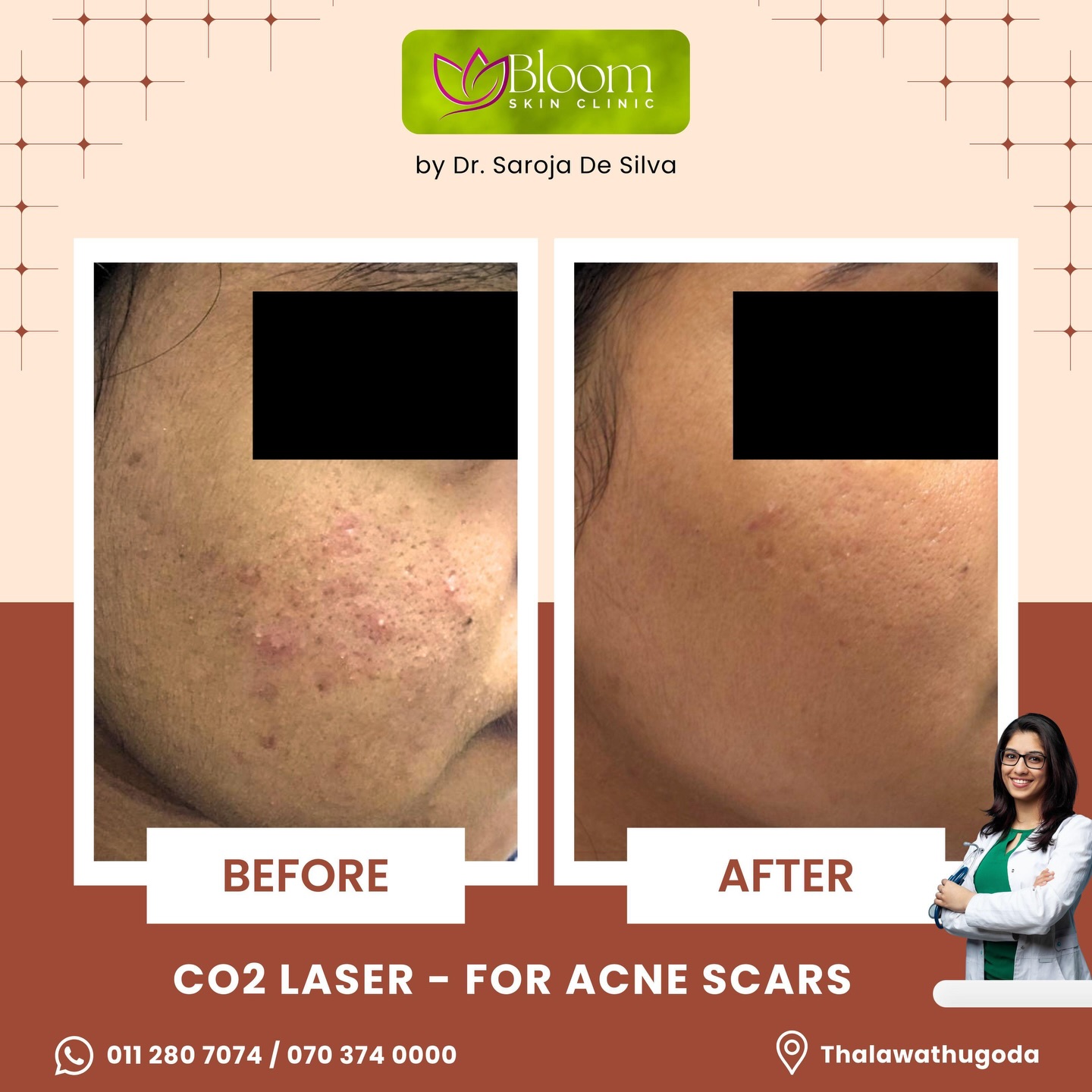 Bloom Skin Clinic Facebook ad: Transform Your Skin with CO2 Fractional Laser!