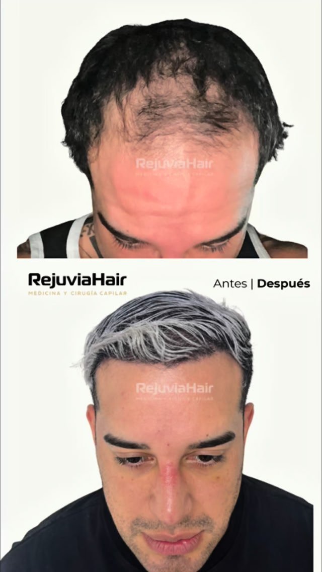 RejuviaHair Facebook ad: Hay niveles bro, Masivo