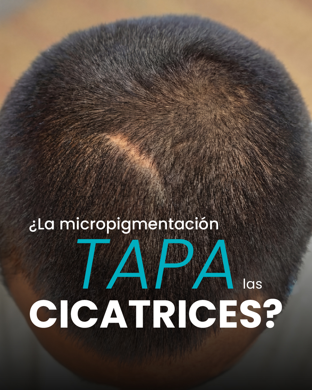 Scalp Capilea Facebook ad: La micropigmentación capilar ayuda a disimular cicatrices…