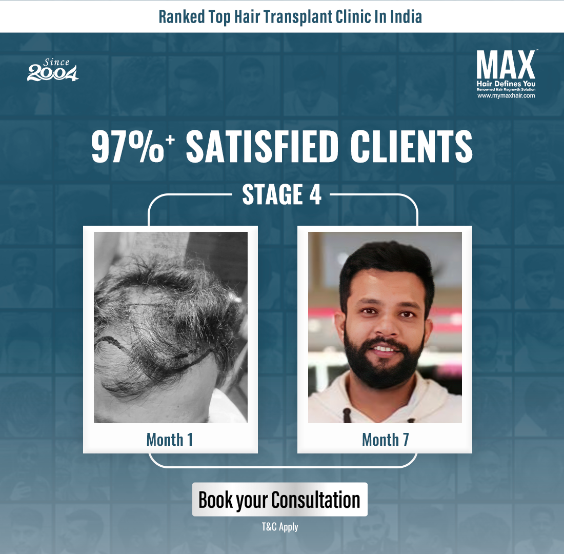 MAX Hair Clinic Facebook ad