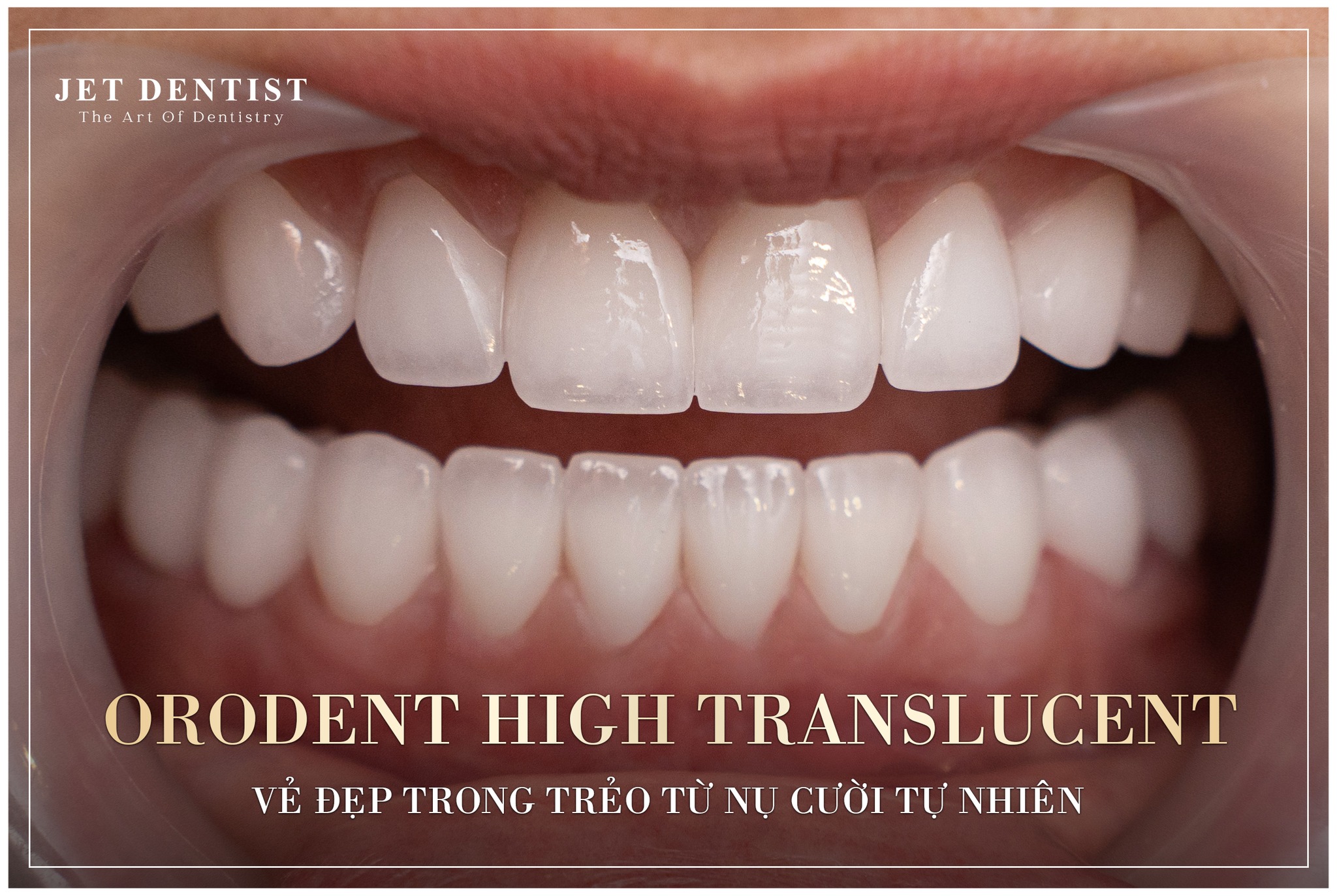 Nha Khoa Jet Dentist Facebook ad: ORODENT HIGH TRANSLUCENT, VẺ ĐẸP TRONG TRẺO TỪ…