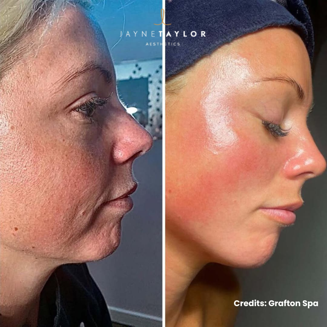 Jayne Taylor Aesthetics Facebook ad: NeoGen Full Face for £549 + FREE Eye Treatment (Worth £300)