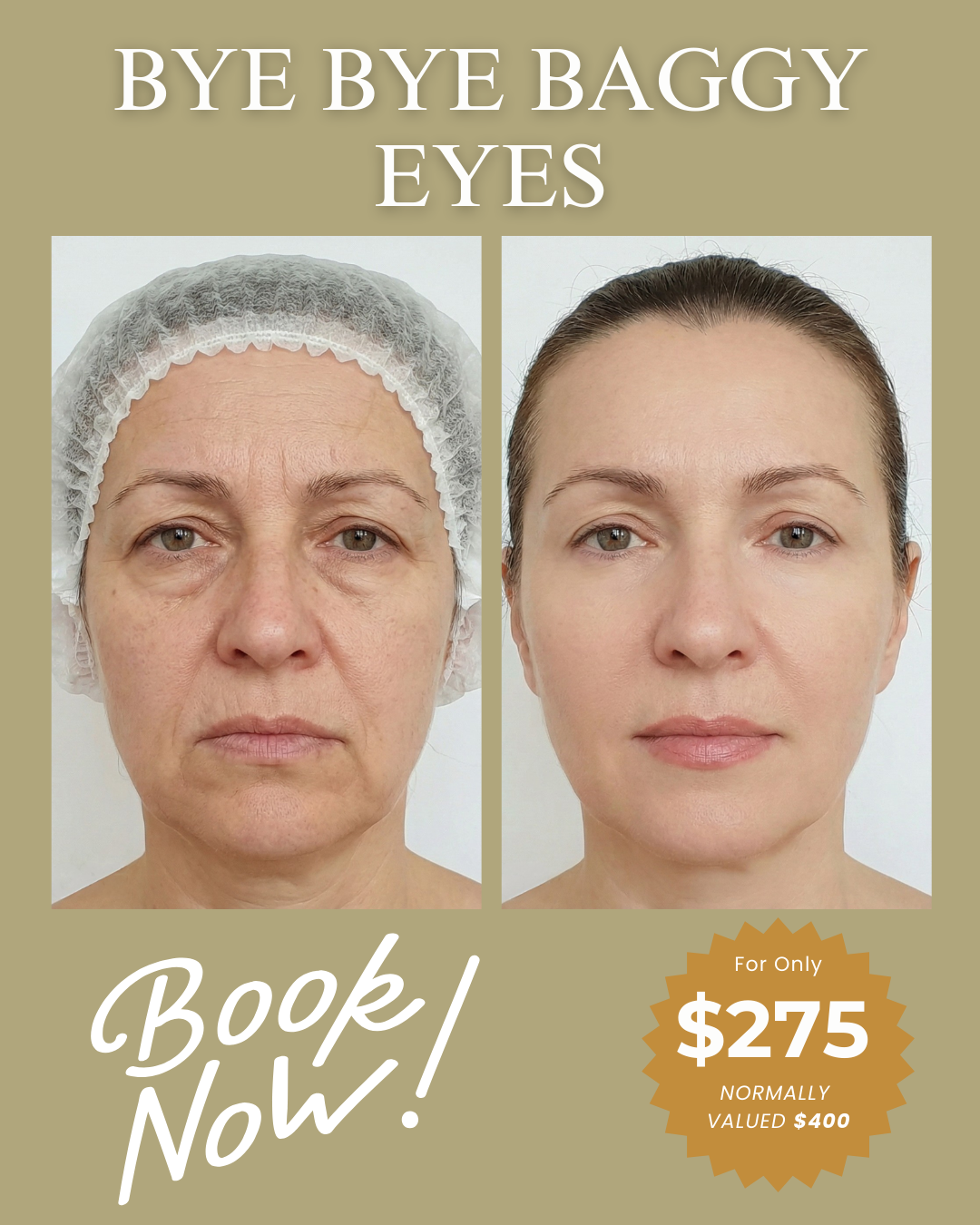 Elite Spa Massachusetts Facebook ad: Bye Bye Baggy Eyes for Only $275!