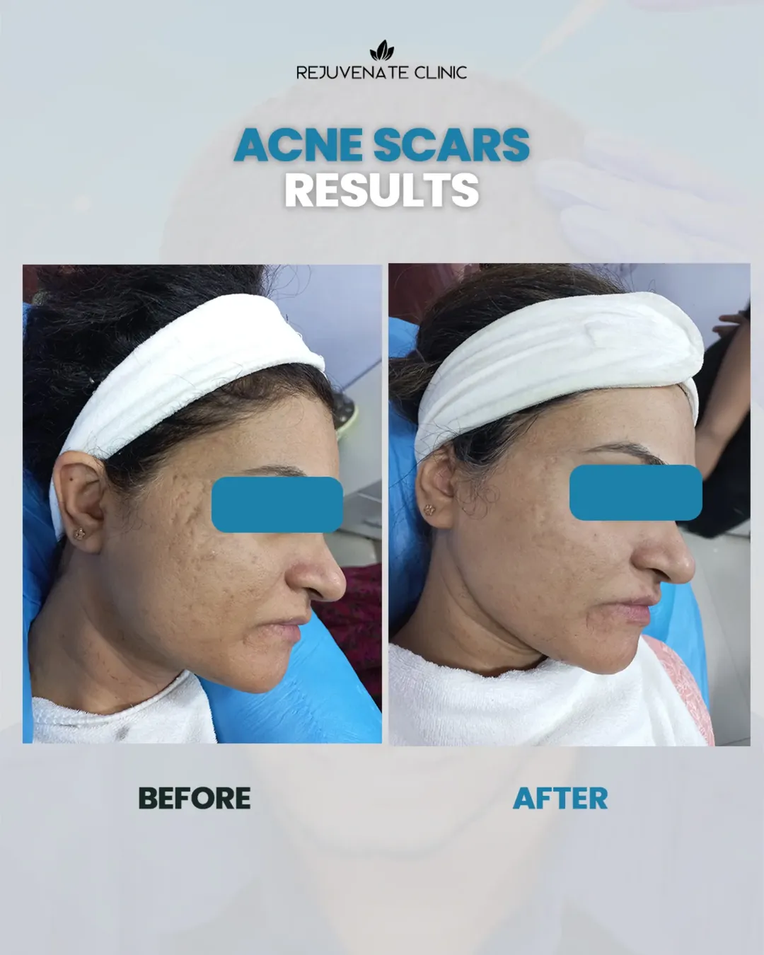 Rejuvenate Clinic Facebook ad: Concerned about acne scars or uneven skin texture?
