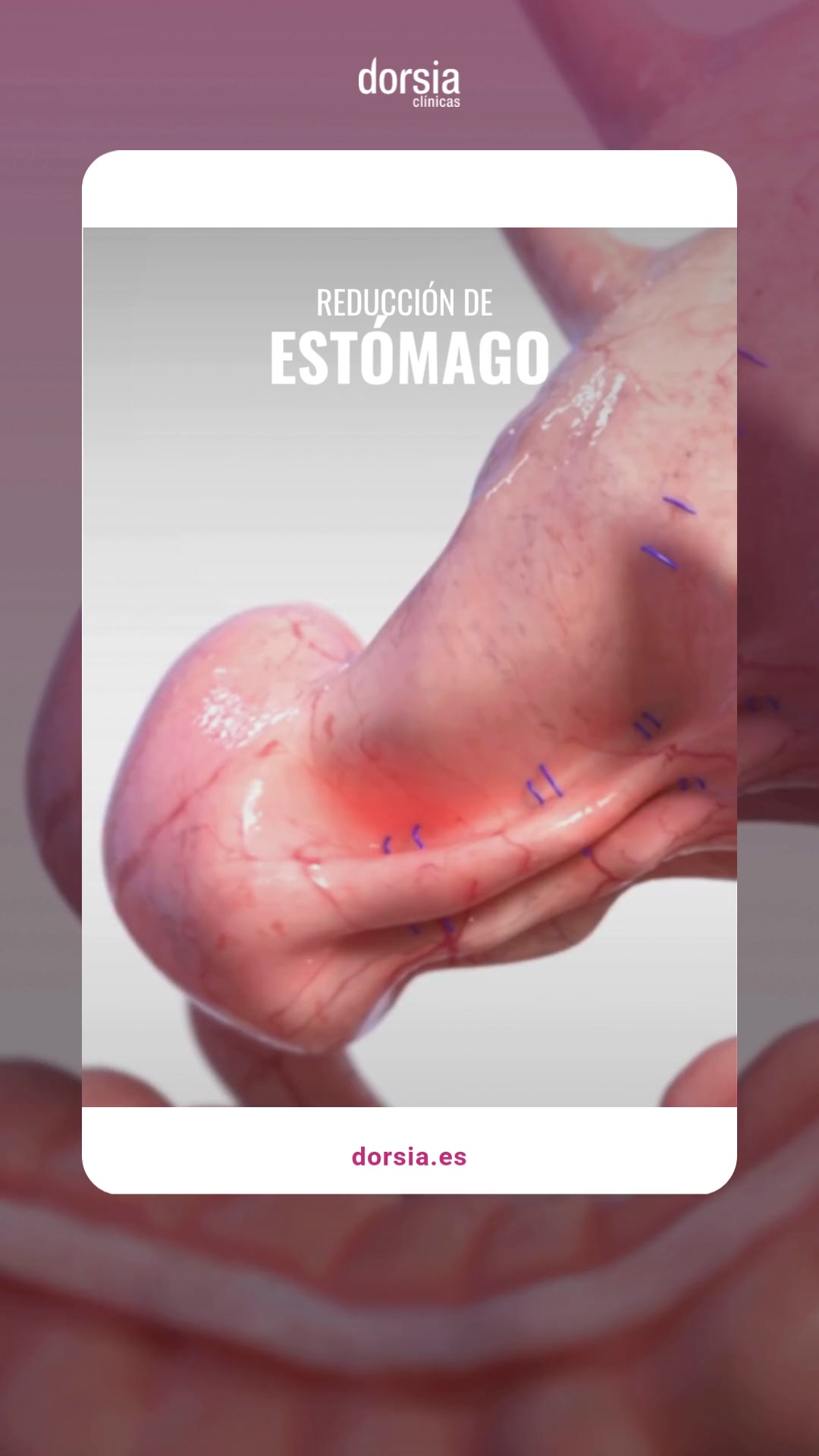 Clínicas Dorsia Facebook ad: REDUCCIÓN DE ESTÓMAGO SIN CIRUGÍA