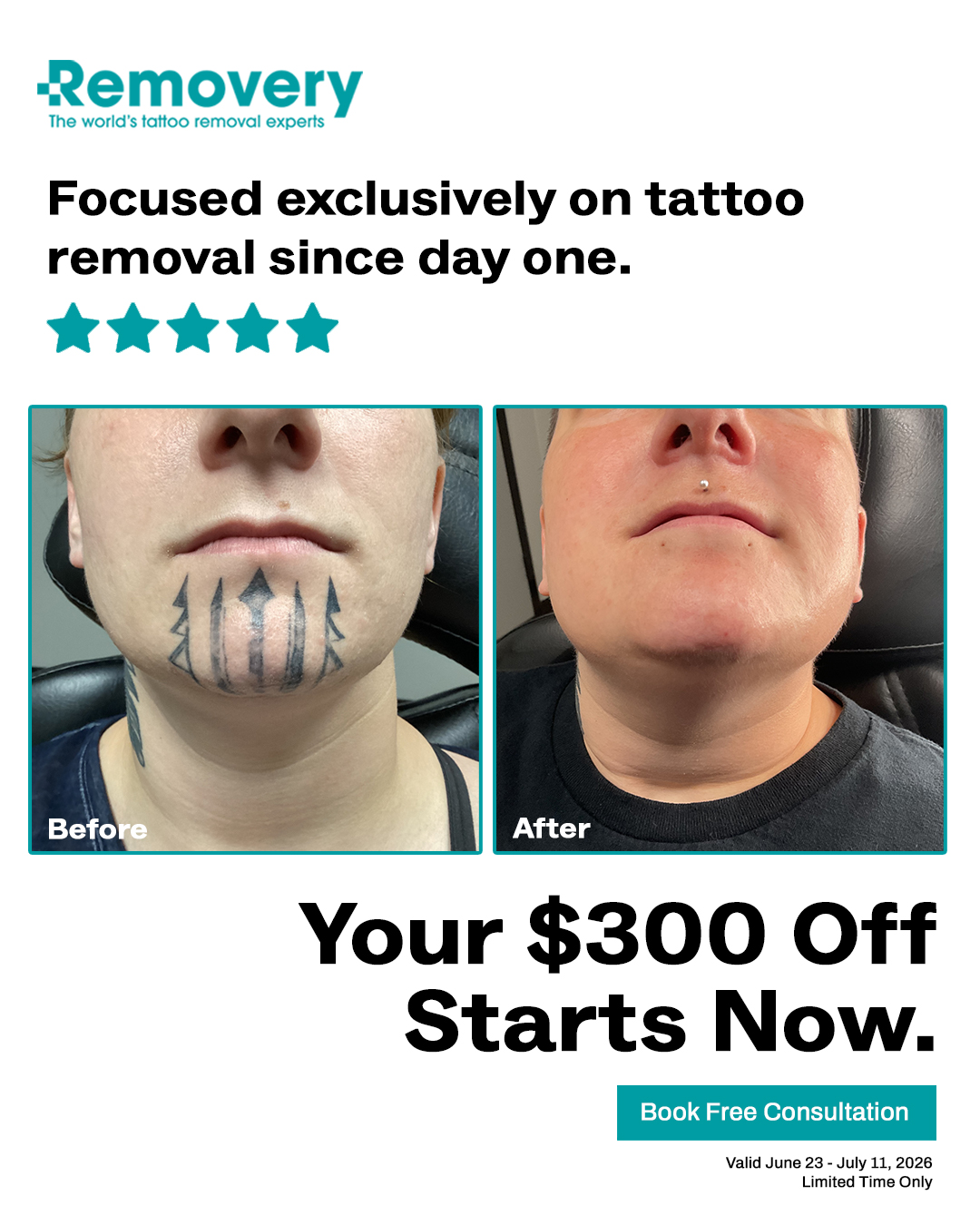 Removery Facebook ad: $300 Off Complete Tattoo Removal Packages.