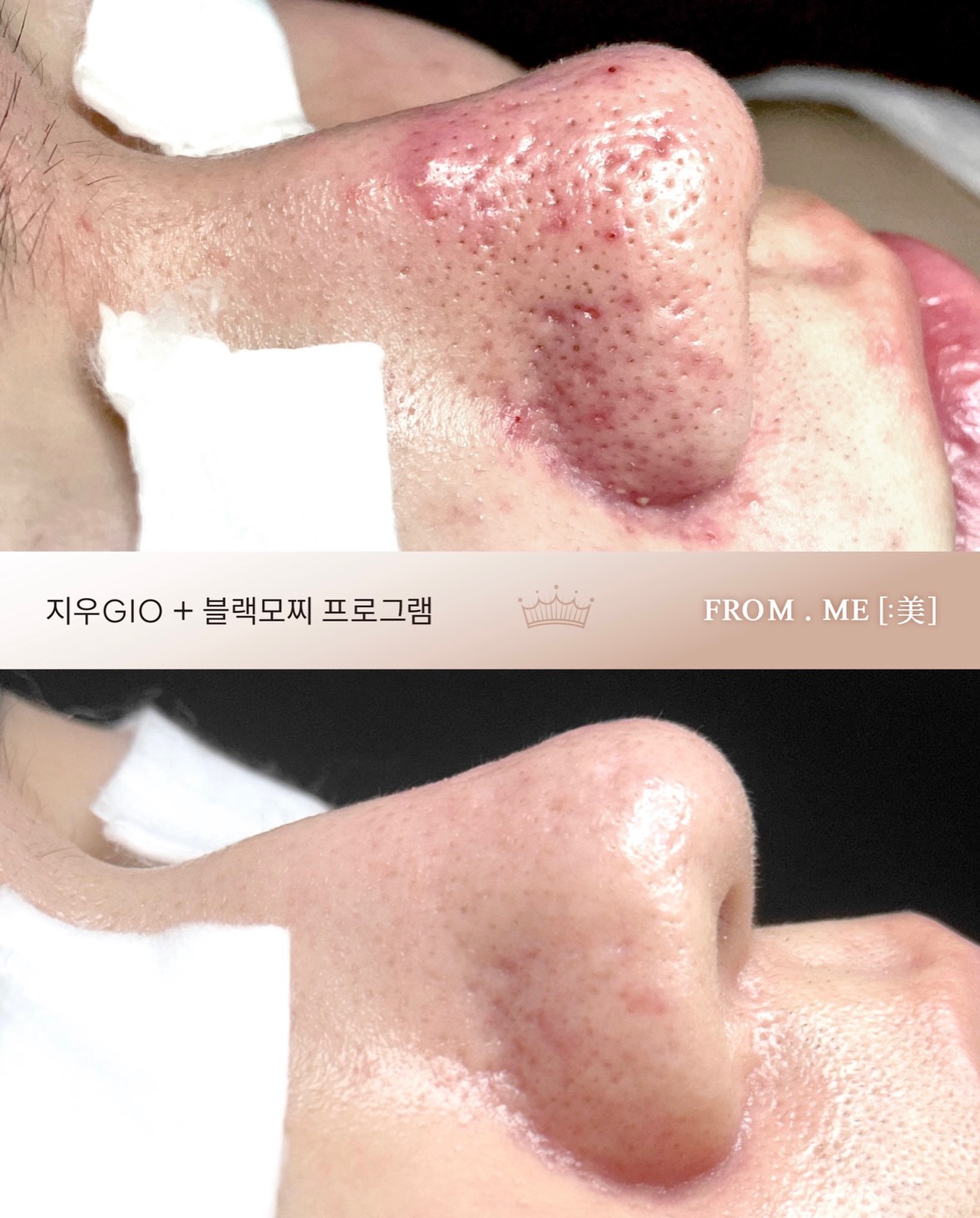 프롬미 울산점 Facebook ad: 모공, 흔적, 색소침착, 잡티, 블랙헤드가 고민이라면?