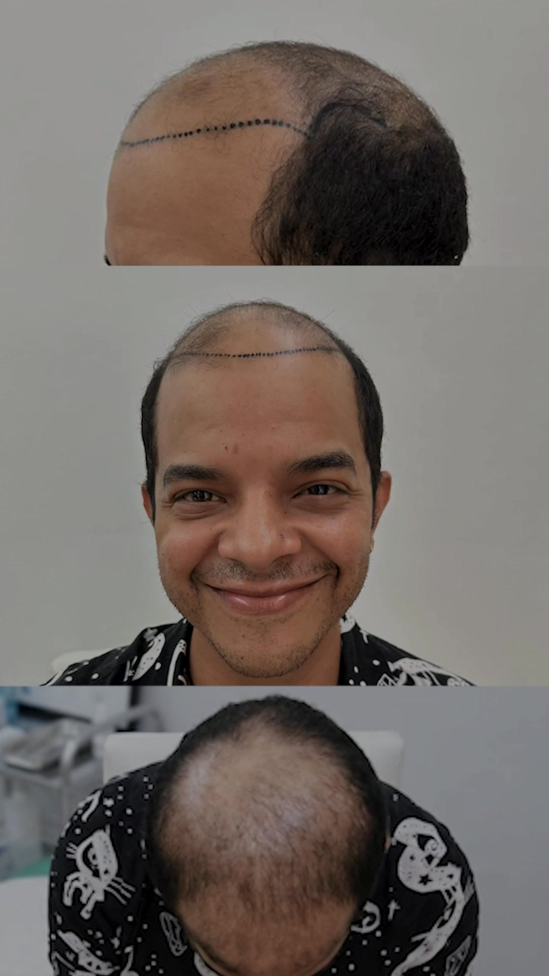 Hair Life Implante Capilar Facebook ad: Chatea con nosotros