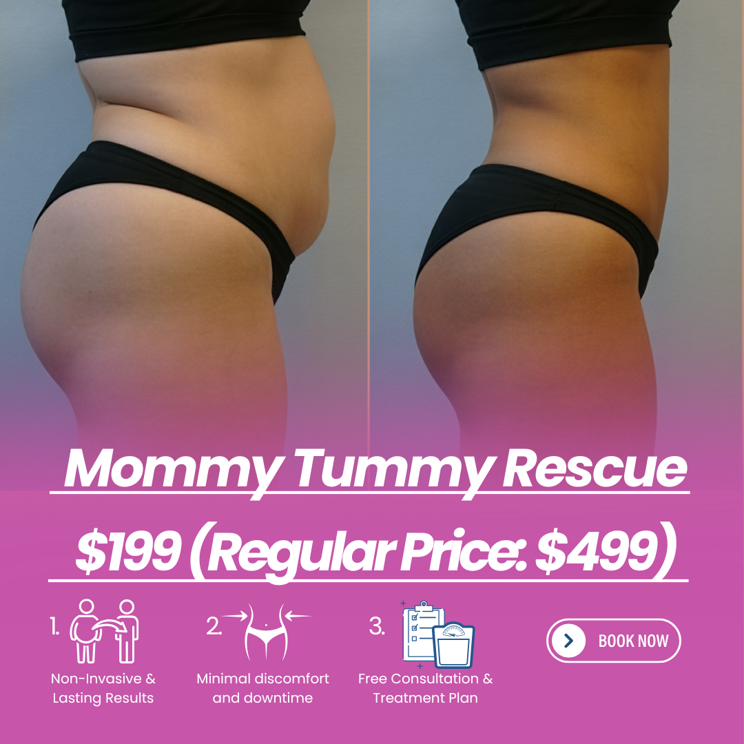 SF Aesthetics & Wellness Facebook ad: Mommy Tummy Rescue: For Only $199!