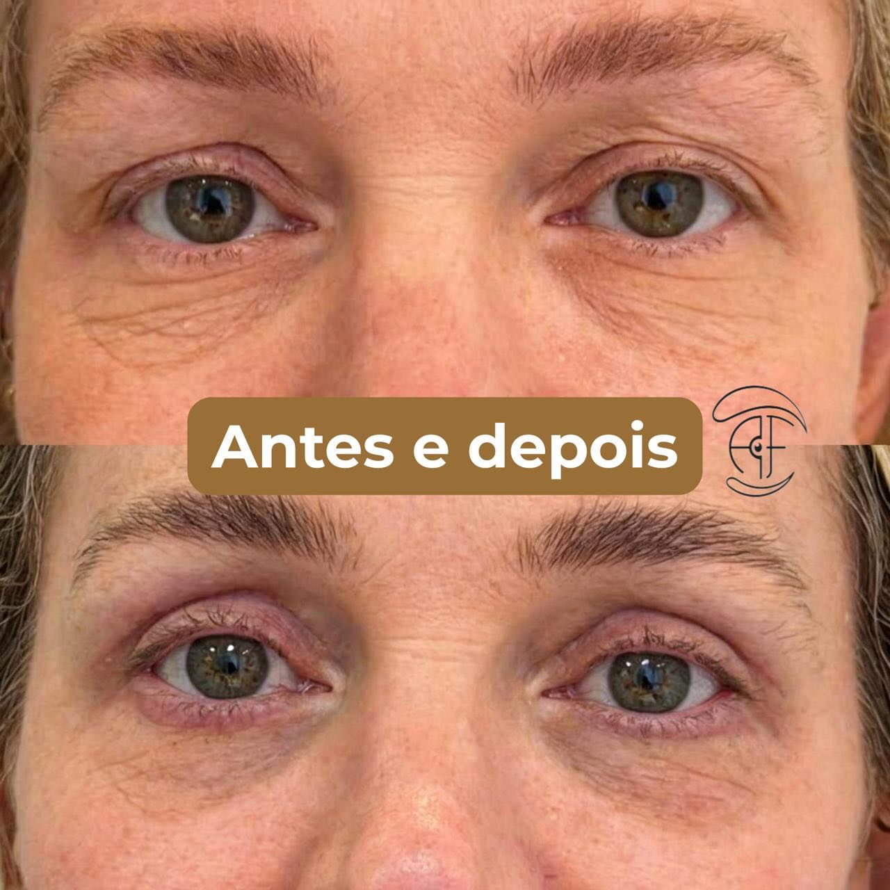 Dra. Ana Flávia Tomich Facebook ad: Essa paciente me procurou principalmente pelo craquelado da…