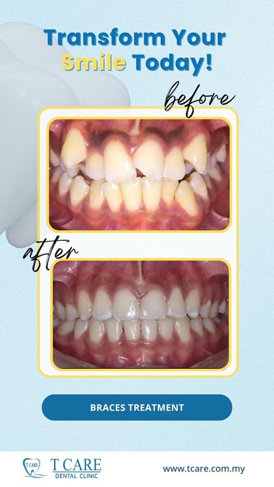 T Care Dental Puchong- Bandar Puteri & Puchong Jaya Facebook ad: Chat with us